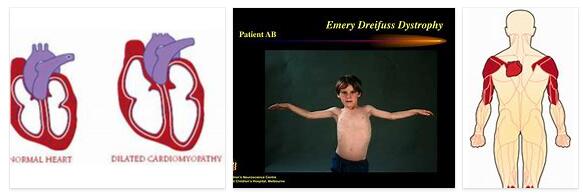 Emery Tripod Muscular Dystrophy